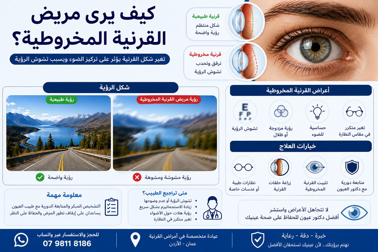 كيف يرى مريض القرنية المخروطية