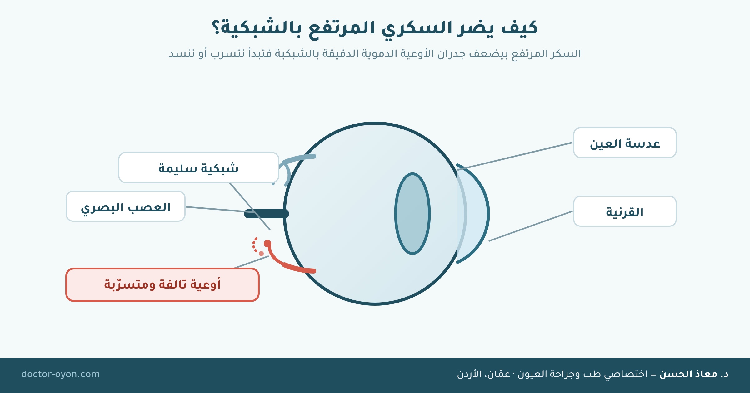 كيف يضر السكري المرتفع بالشبكية