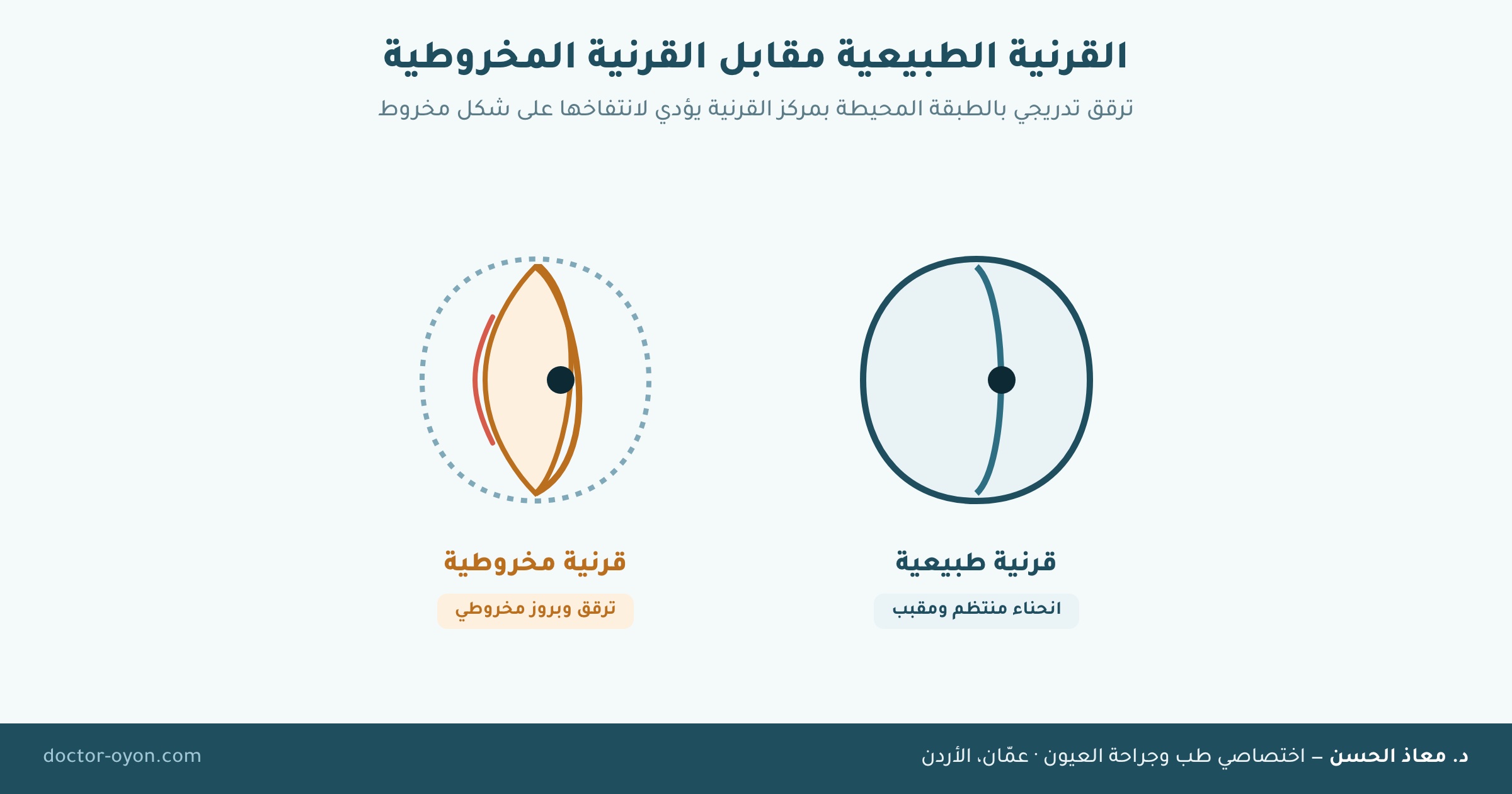 القرنية الطبيعية مقابل القرنية المخروطية