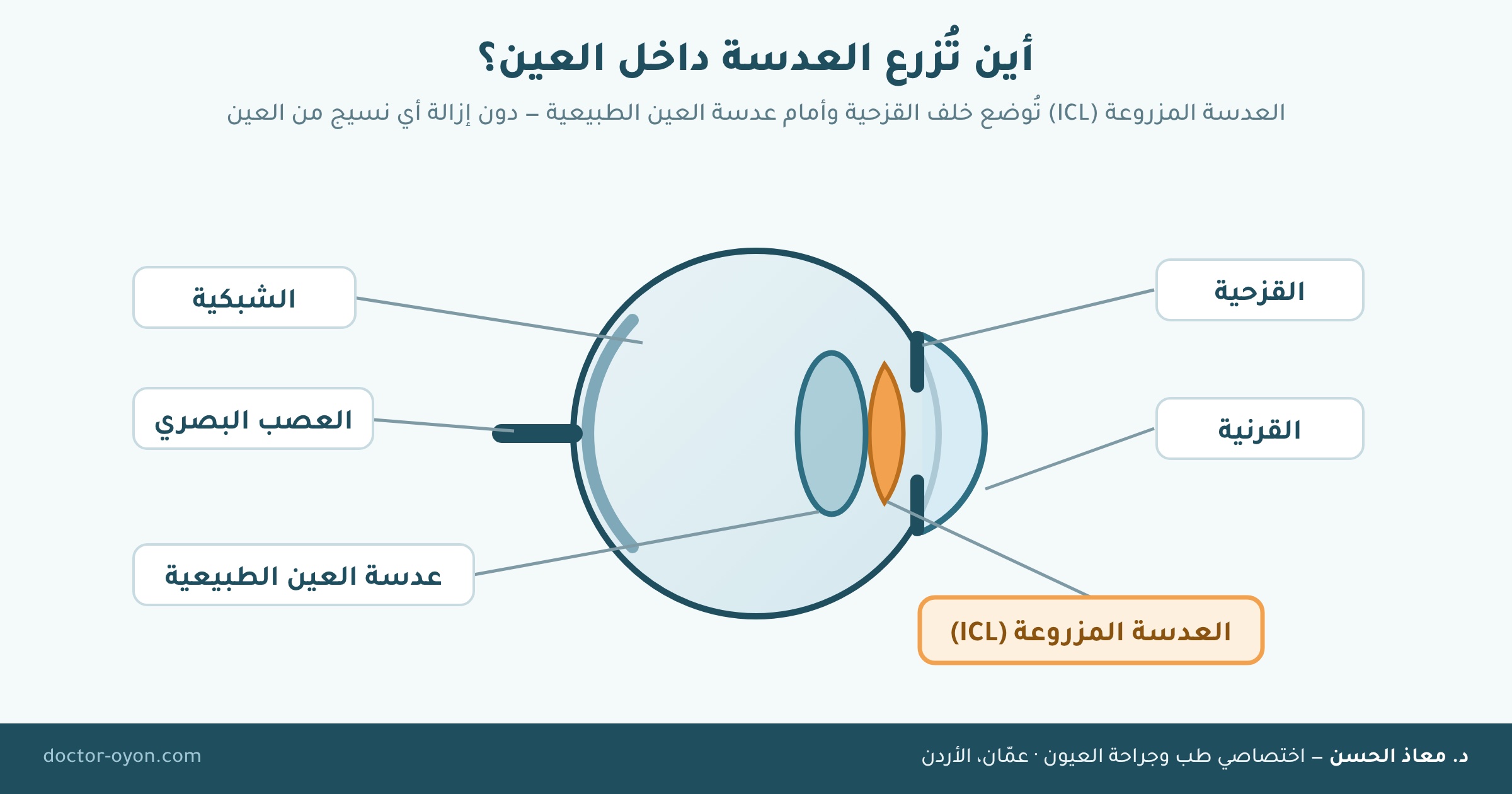 أين تُزرع العدسة داخل العين